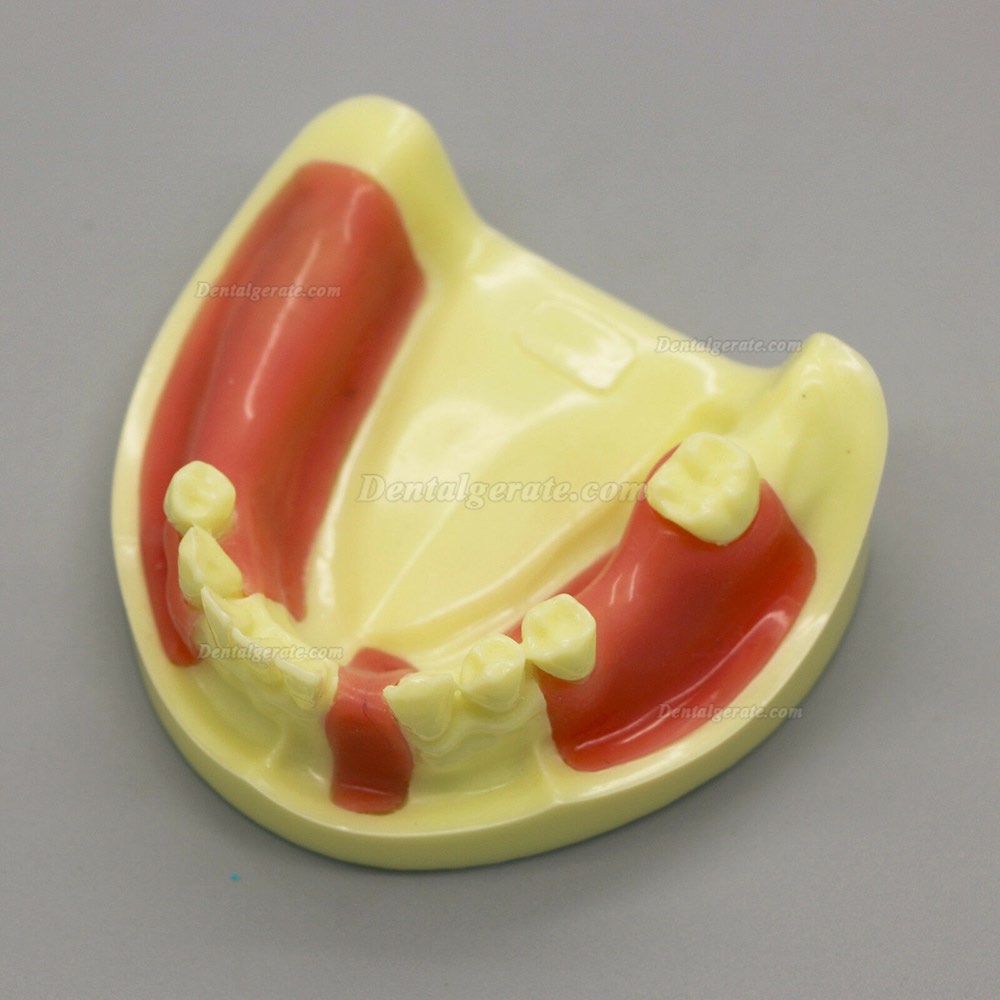 Dental Model # 2004 01 - Unterkieferimplantat-&Uuml;bungsmodell mit Gingiva